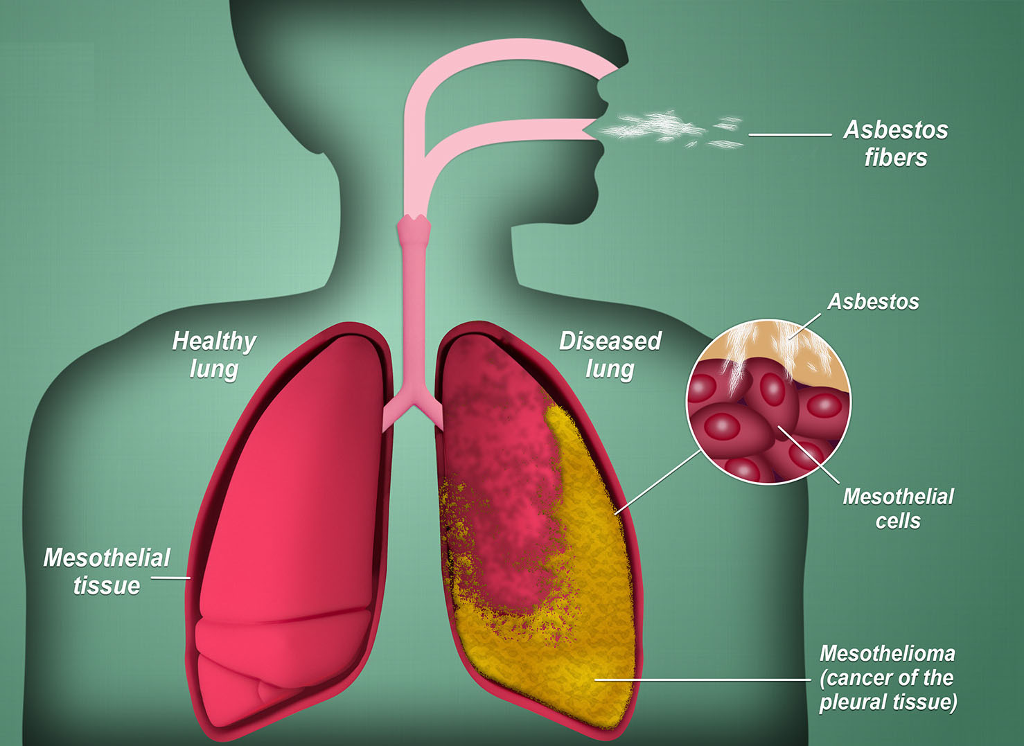 asbestos removal in kent